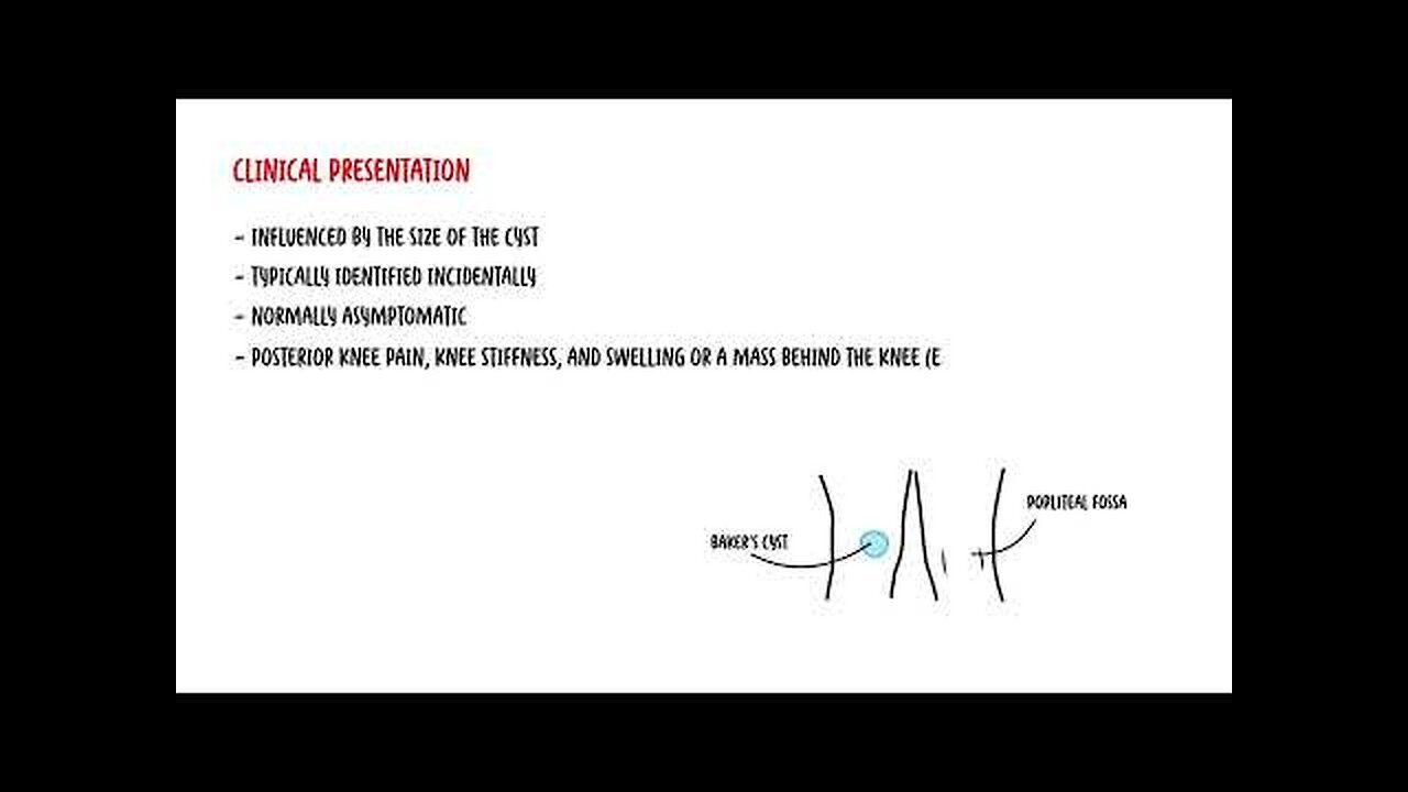 Baker's Cyst Knee - posterior knee swelling and pain