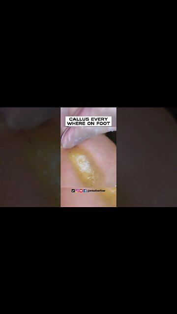 CALLUS EVERYWHERE ON FOOT 2023 [ NEVER ENDING CALLUS SCRAPING ] BY FOOT SPECIALIST MISS FOOT FIXER