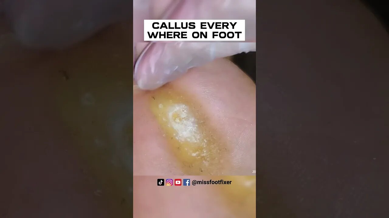 CALLUS EVERYWHERE ON FOOT 2023 [ NEVER ENDING CALLUS SCRAPING ] BY FOOT SPECIALIST MISS FOOT FIXER