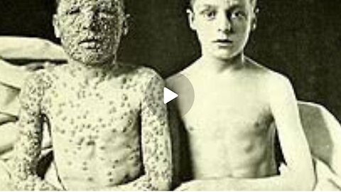 Small Pox Lie Corrected| What You Should Have On Hand If They Bio Weapon Small Pox