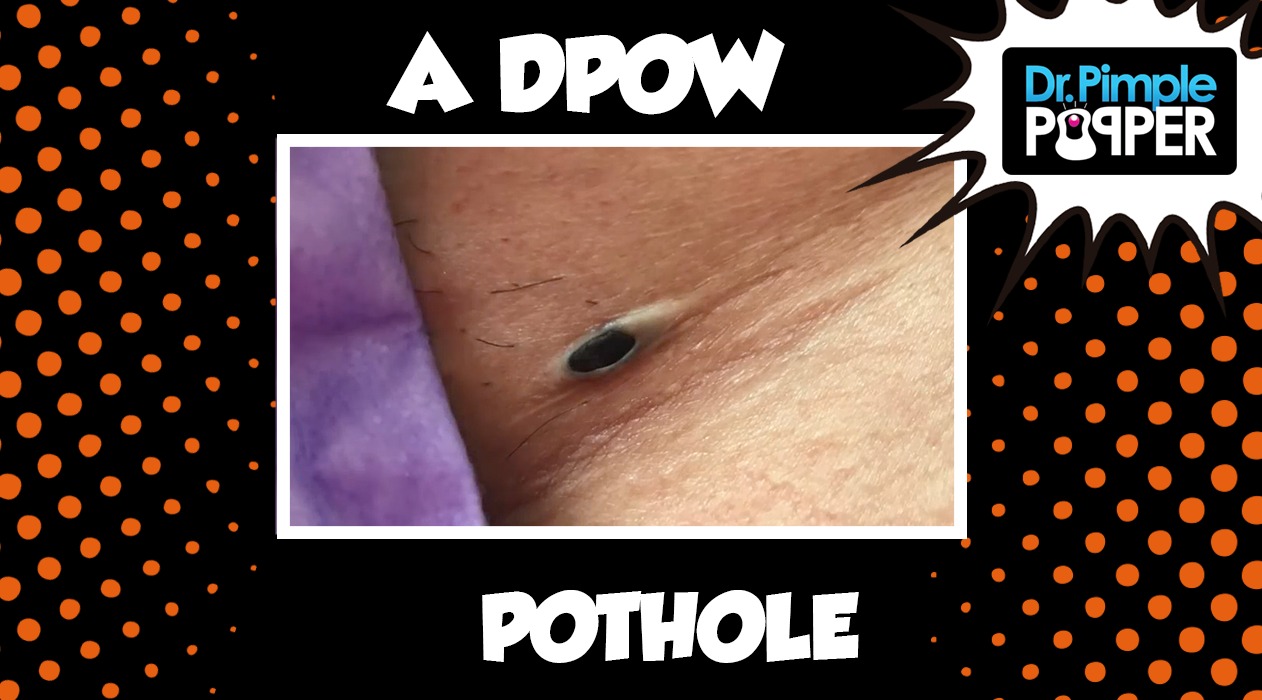 A Little DPOW Pothole