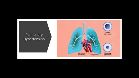 Pulmonary Hypertension - Natural Treatment