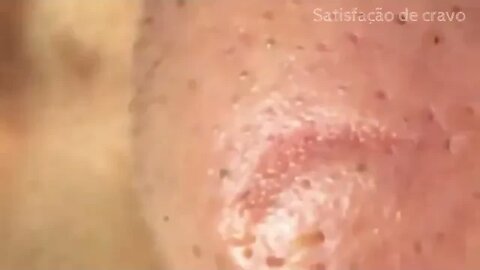 Cravos profundos no nariz I safistação total!! Blackheads removal