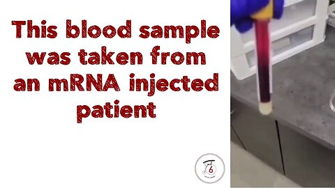 This blood sample was taken from an mRNA injected patient.