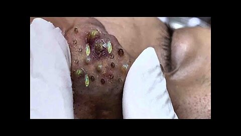 Big Cystic Acne Blackheads Extraction Blackheads