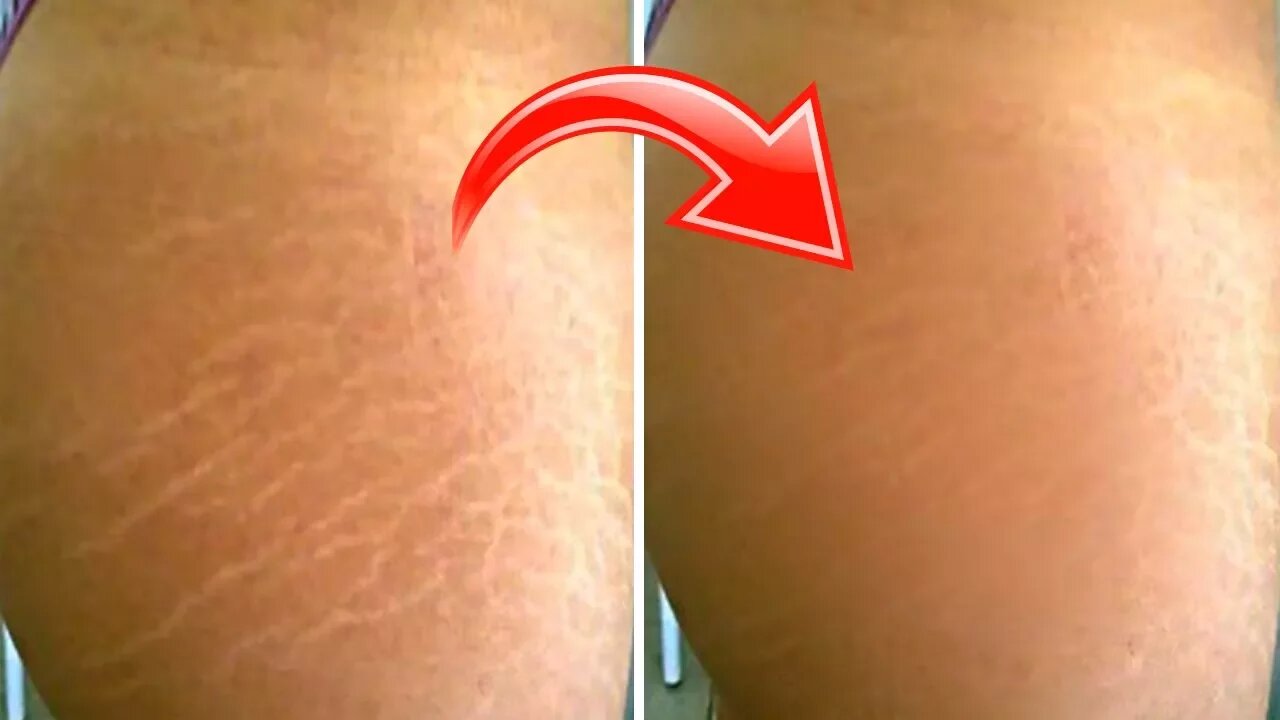 Mix These 3 Ingredients to Quickly Fade Your Stretch Marks