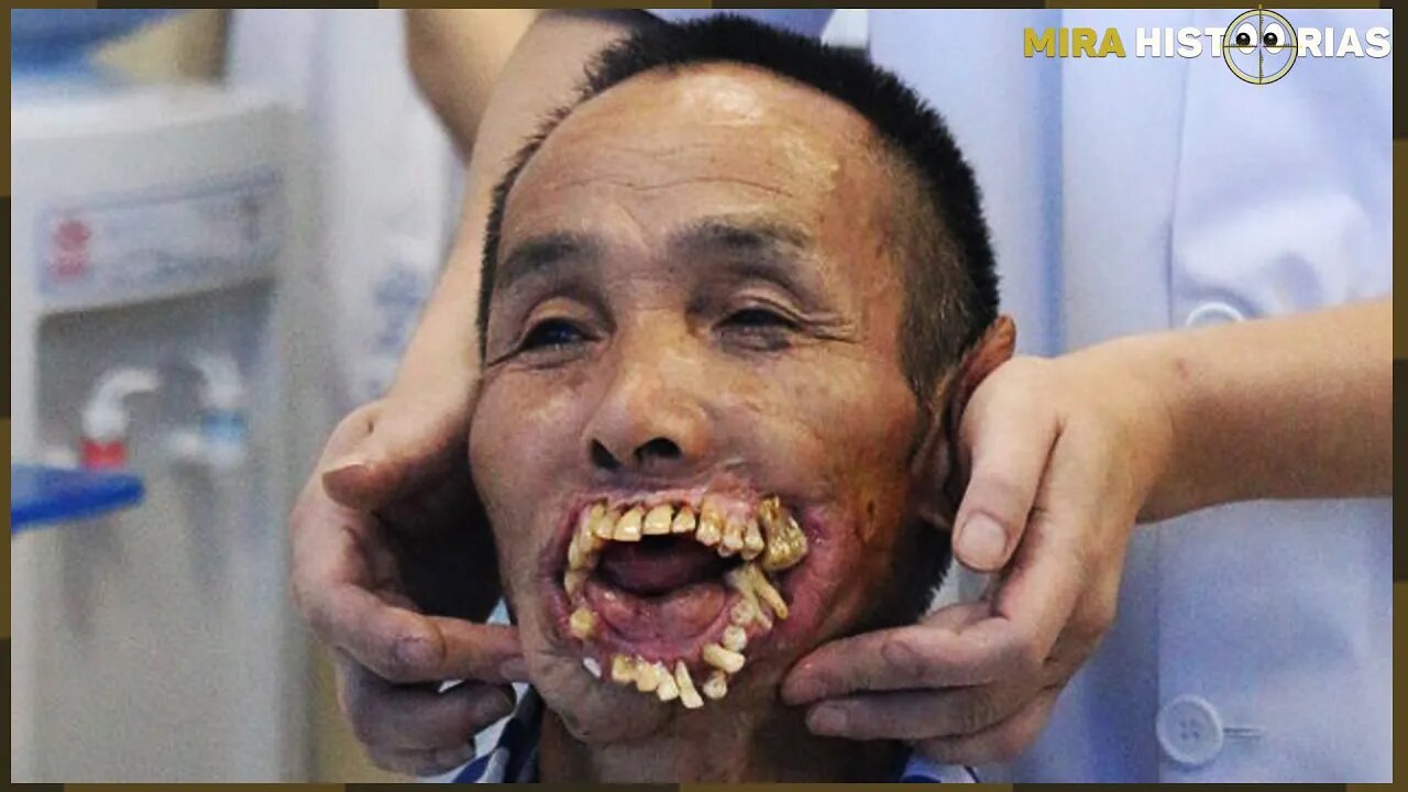 Este homem enfrentou um lobo e ficou deformado. Mas, finalmente ele fez a 1º cirurgia corretiva