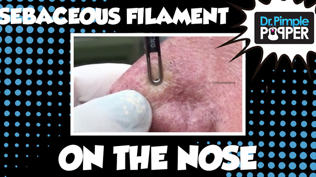 Sebaceous Filaments Extracted on the Nose