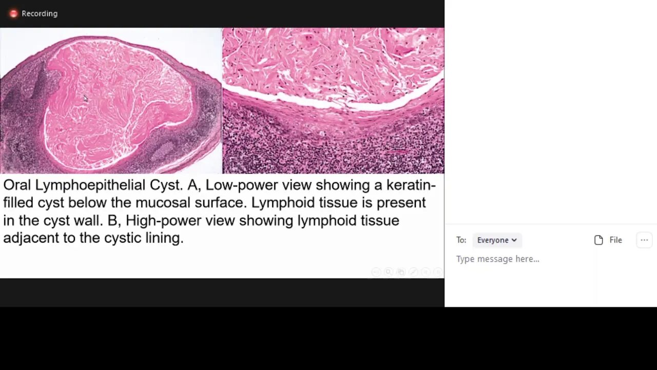 pathology L7 part2 (gingival cyst)