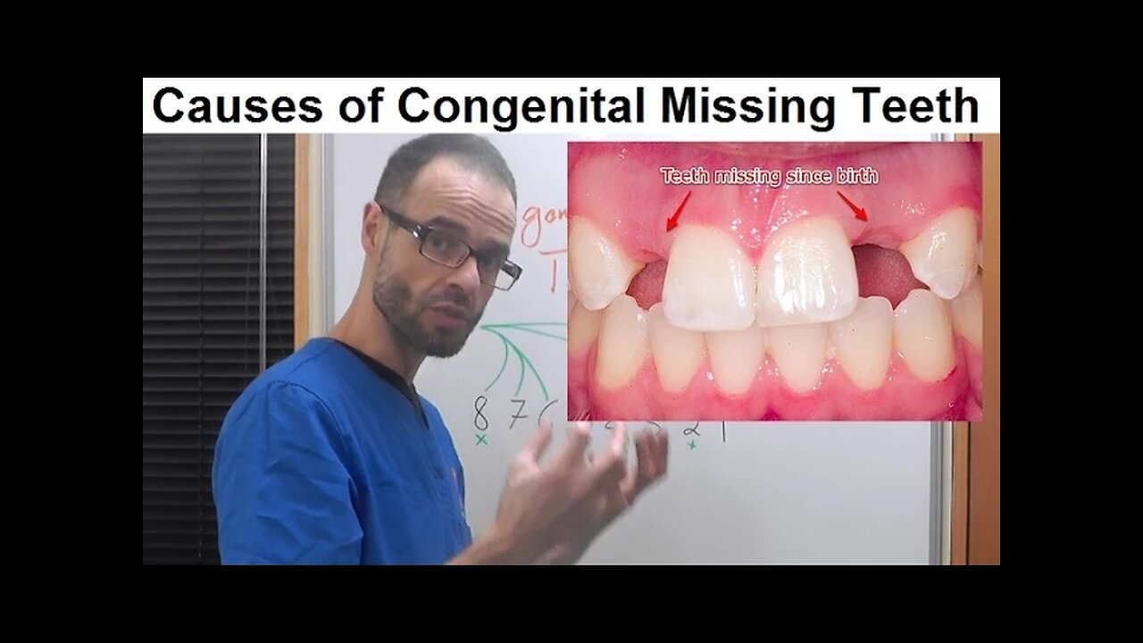 Causes of Dental Anomalies, Congenital Missing/Absence of Permanent Teeth by Dr Mike Mew