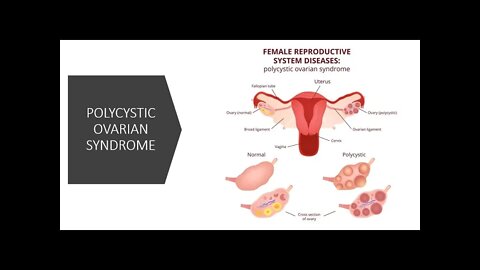 PCOS - Polycystic Ovarian Syndrome - Natural Treatment