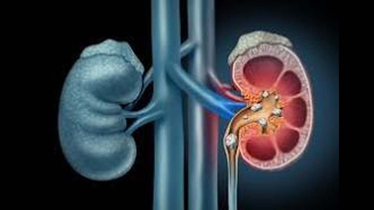 Kidney Stones | Renal Stones | Renal Calculi | Nephrolithiasis