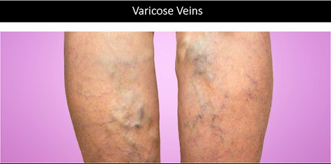 Varicose Veins - Natural Treatment