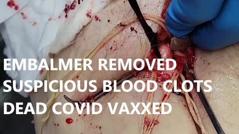 Embalmer Whistleblower Warns us Suspicious Mysterious Blood Clots Getting Worse in Dead Covid Vaxx