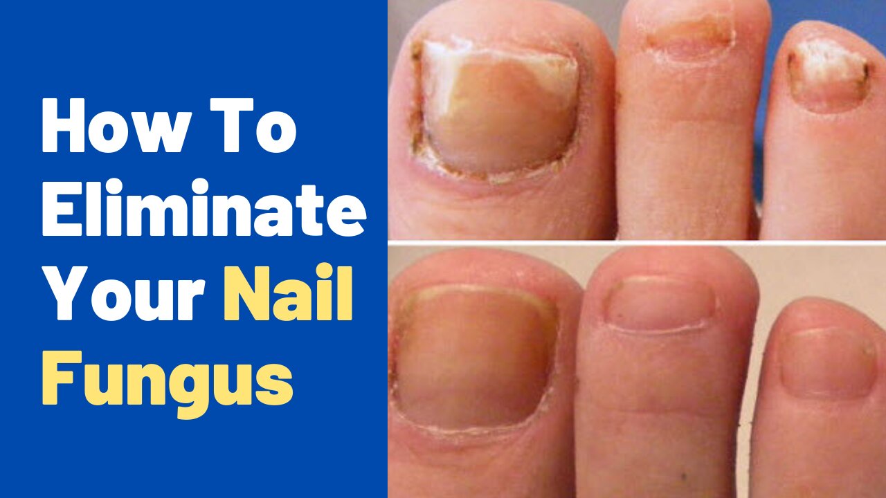 Have Nail Fungus? YOU NEED TO BE DOING THIS TO CURE YOUR NAIL FUNGUS!!!!