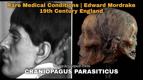 Horrific Medical Anomaly of the Man With the 2 face | Edward Mordrake