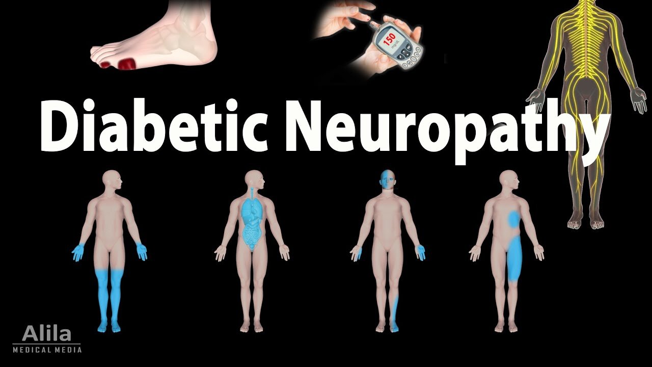 Neuropathy