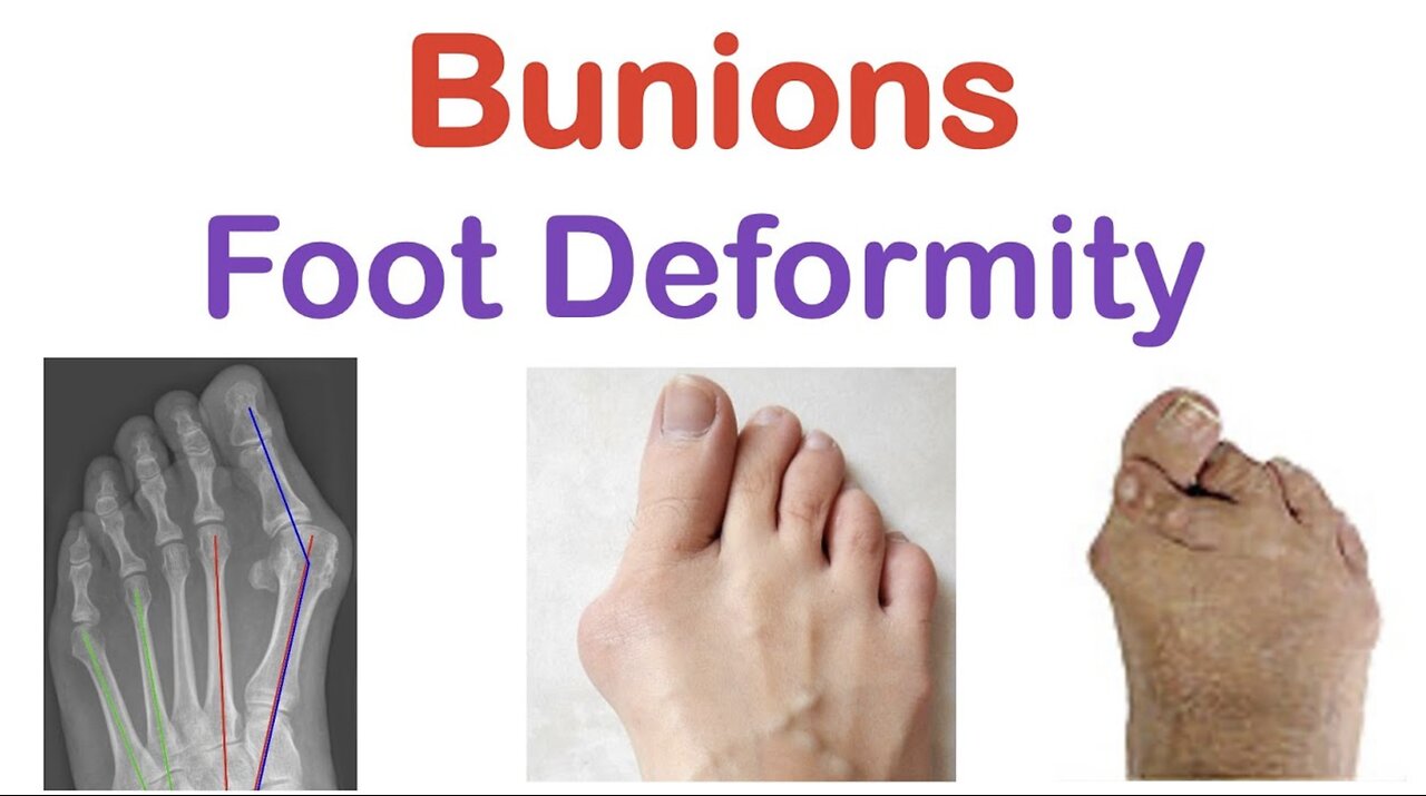 Bunions (Foot Deformity) | Types (& Bunionettes), Risk Factors, Symptoms, Diagnosis, Treatment