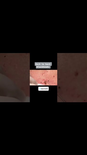 Blackheads Removal on the Back PART 1