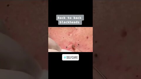 Blackheads Removal on the Back PART 1