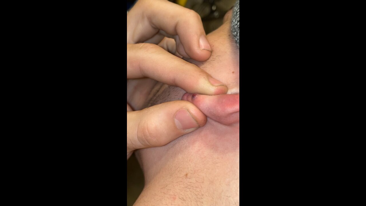 Infected ear popping video
