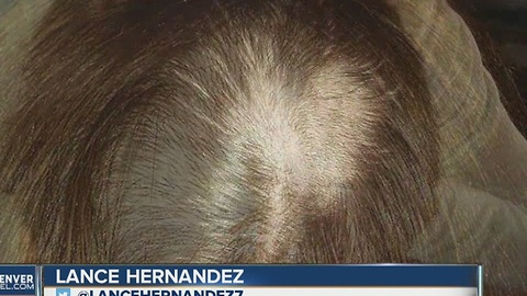 Colorado woman says drug test left her with bald spot