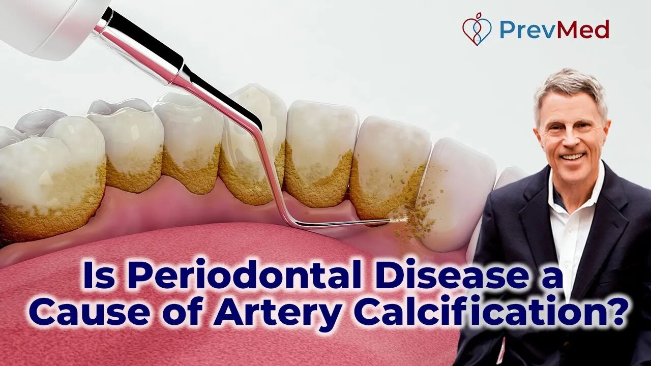 Is periodontal disease a cause of artery calcification?