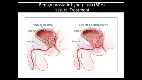 Benign Prostatic Hyperplasia - Natural Treatment