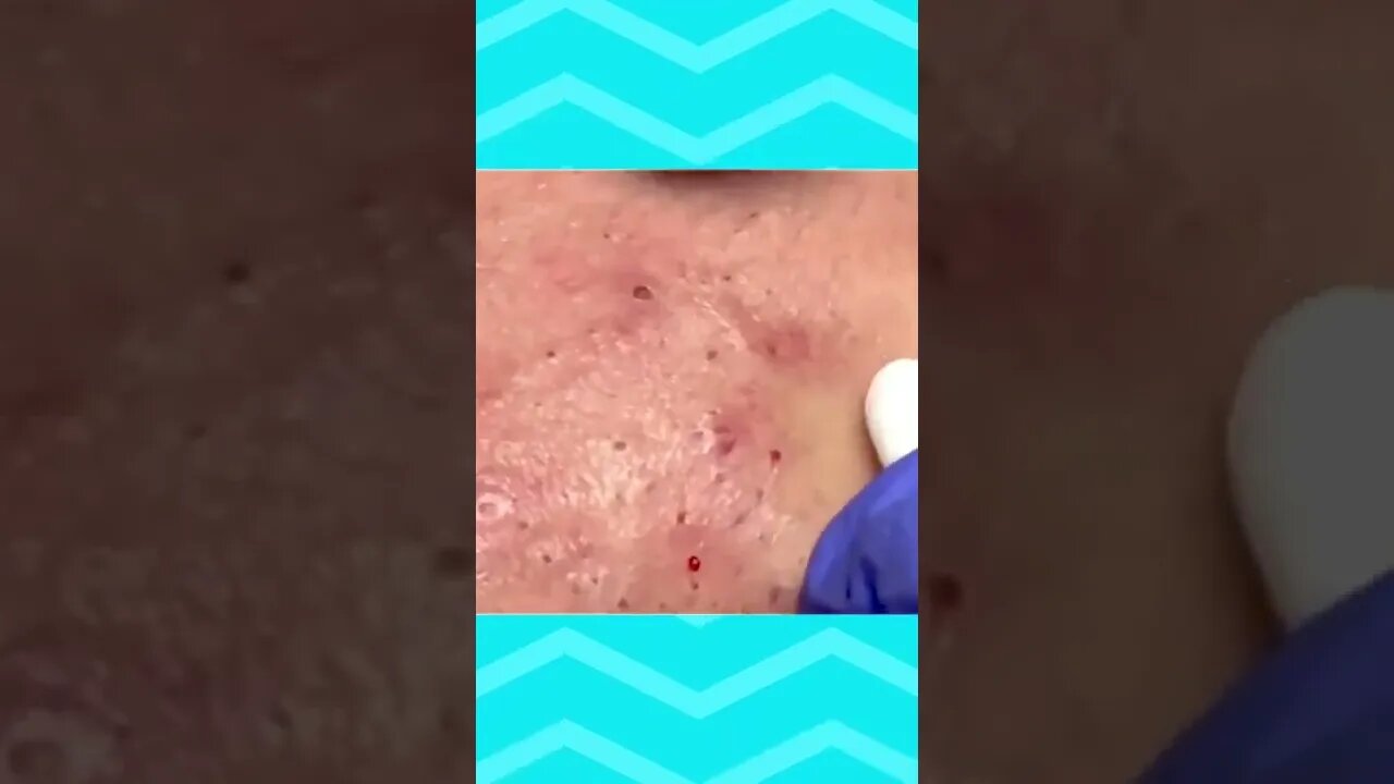 Blackheads and Pimples Removal Skin Cleansing #2 Relaxing Videos #short