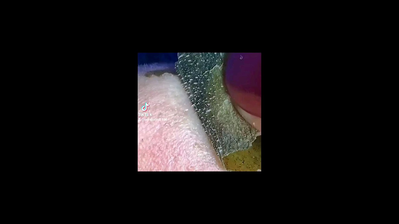 Blackheads Massive!