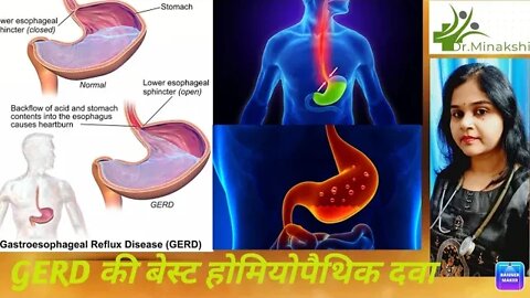 GERD| बदहजमी, खट्टी डकारें और मुंह में खाना वापस आता है??