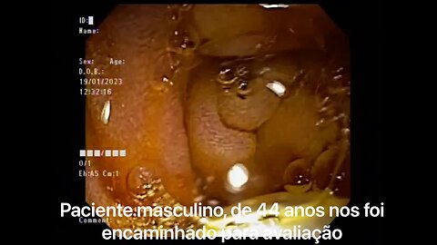 Largue Ampullary Adenoma. Endoscopic Ampullectomy (legendas em português).