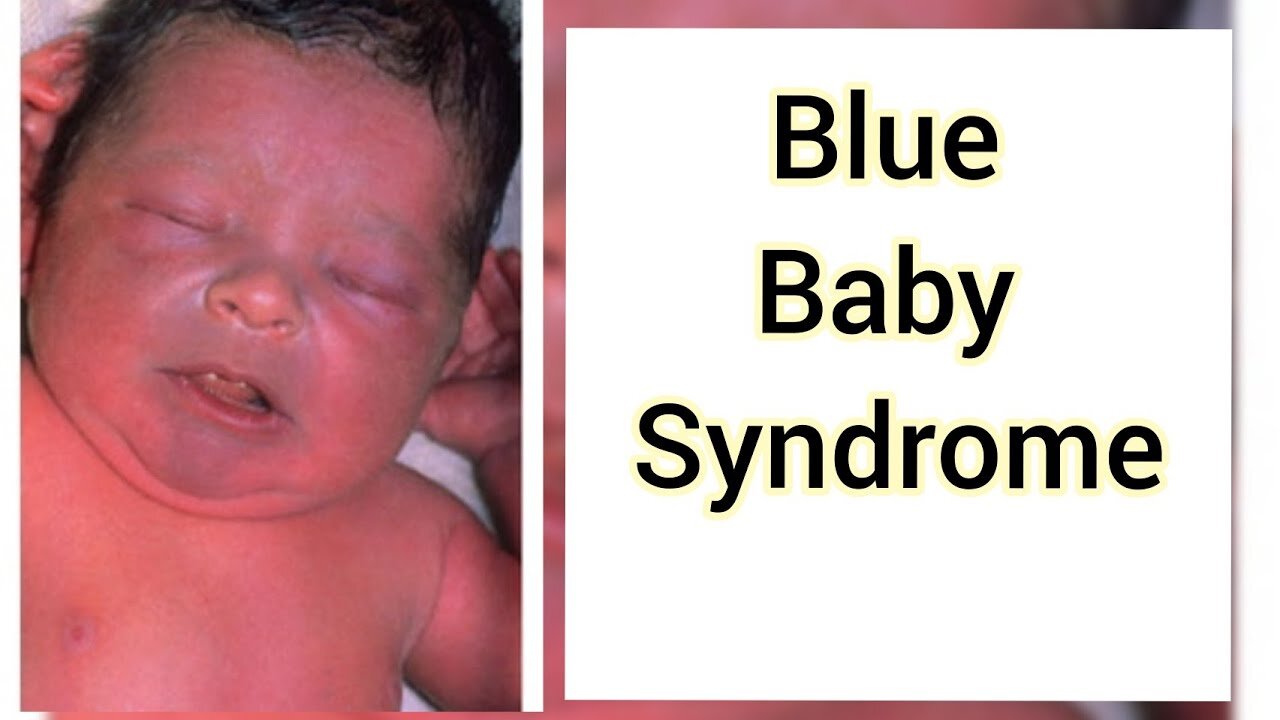 The RH Negative Blood Type: Miscarriages, Blue Babies & Blood Transfusions
