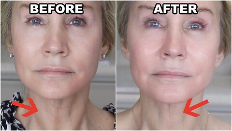 NECK WRINKLE CURE AT HOME? | NO SURGERY OR FILLERS!