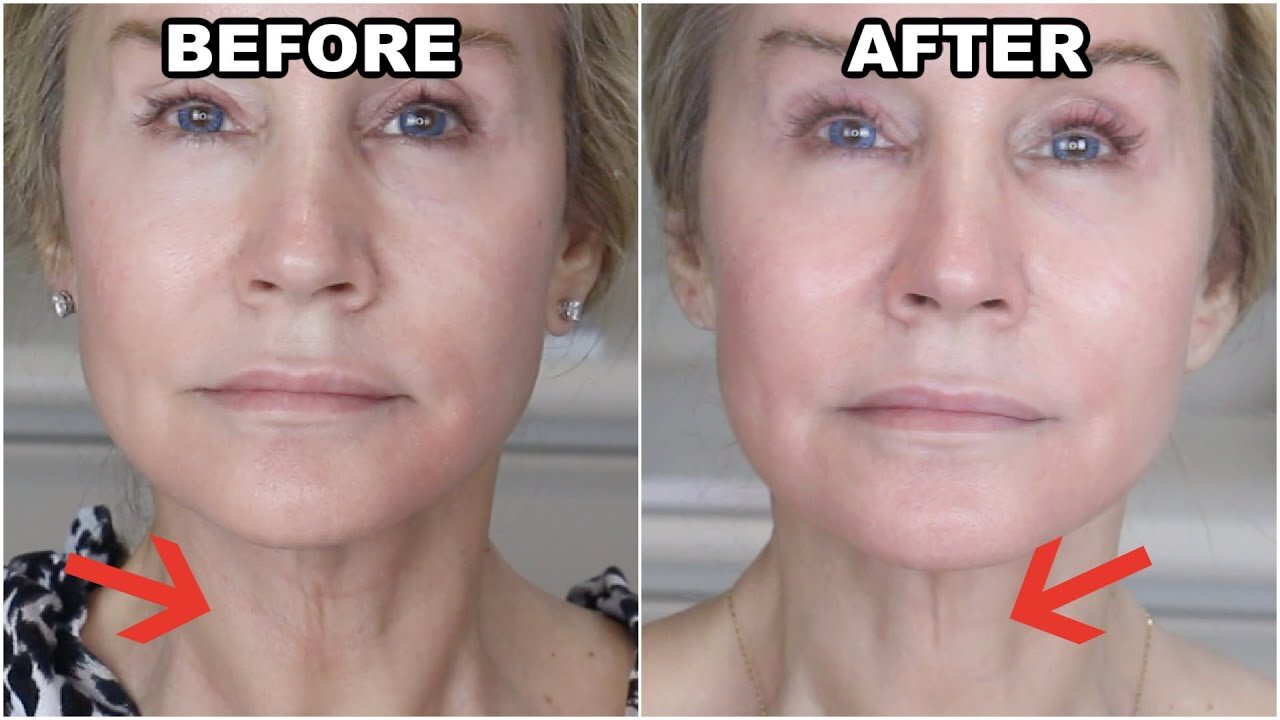NECK WRINKLE CURE AT HOME? | NO SURGERY OR FILLERS!