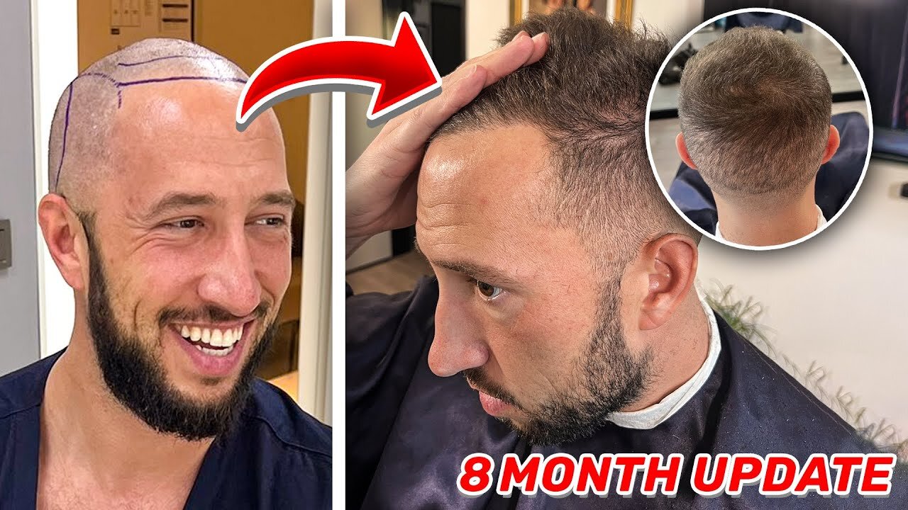 My $2000 Hair Transplant Surgery Changed My Life | The Night Shift