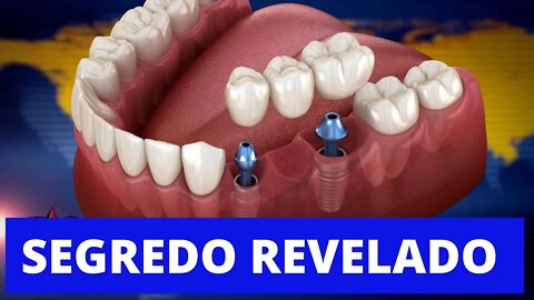 💥 ESCOLHA ONDE FAZER SEU IMPLANTE DENTÁRIO, CONHEÇA ONDE FIZ O MEU!