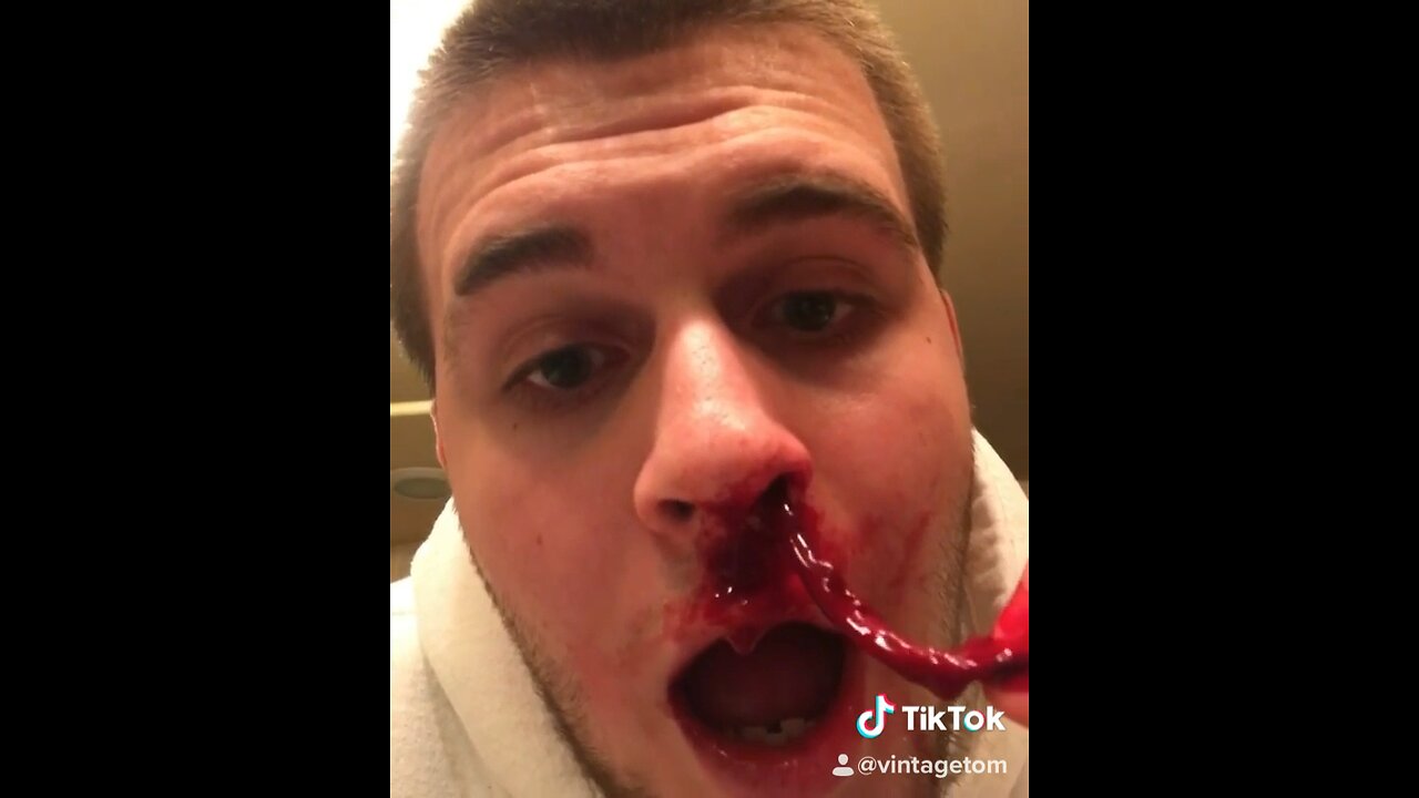 Blood Clot Coming Out Of Nose