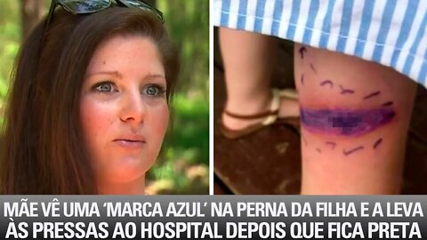 Mãe Vê 'Marca Azul' Na Perna Da Filha e A Leva Às Pressas Ao Hospital Depois Que Fica Preta