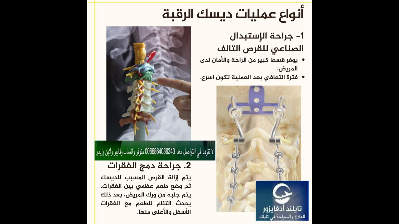 أفضل مستشفي لعلاج الديسك بالليزر في تايلند - علاج العمود الفقري والإنزلاق الغضروفي بدون جراحة