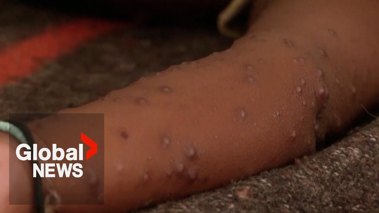 1st case of Mpox outside of Africa confirmed in Sweden