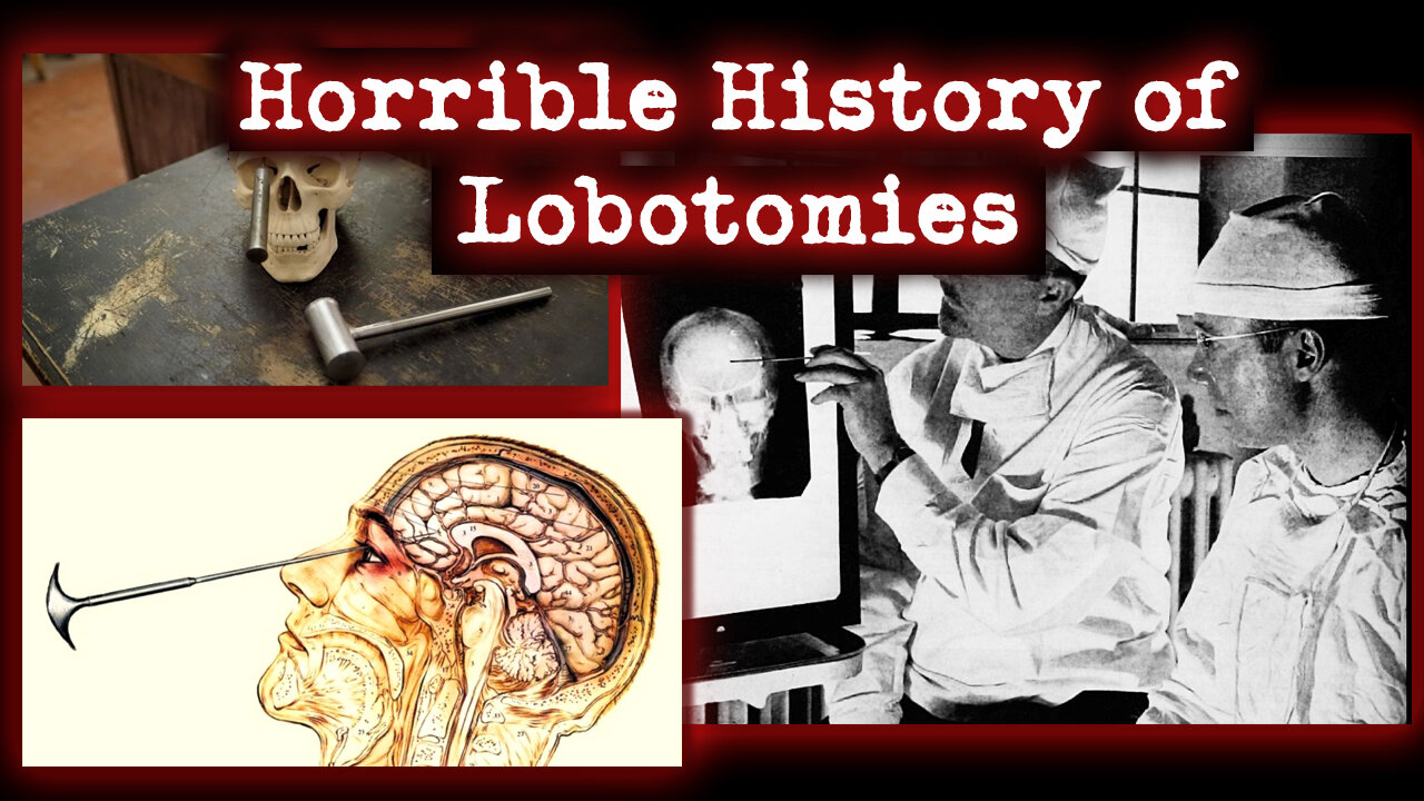 The Lobotomy: A Medical Procedure Gone Wrong