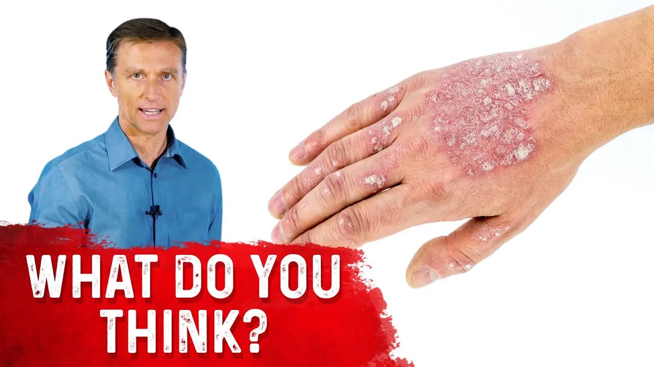 What is Psoriasis and Is Psoriasis Contagious? Explained by Dr.Berg