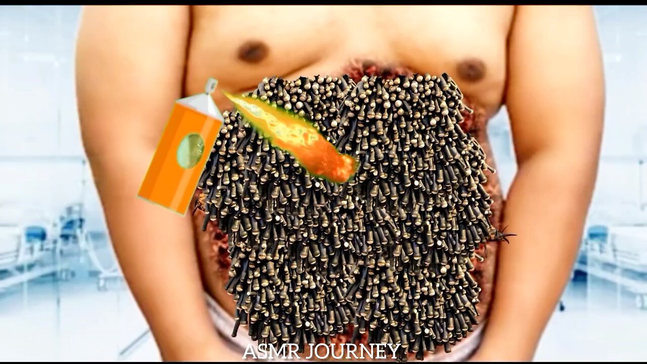 ASMR Trypophobia: Infected Human Belly Removal Maggots in 2D Animation Asmr | #asmr #asmrsounds