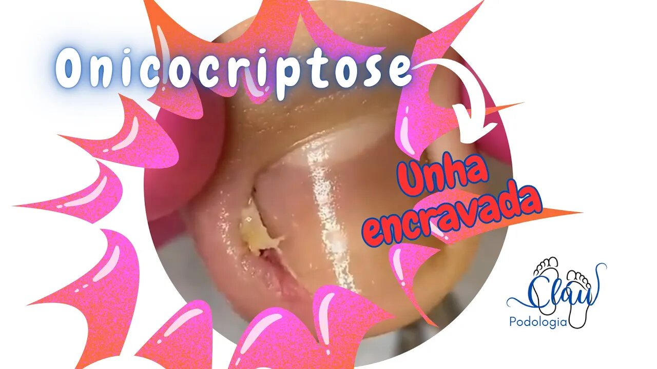 ONICOCRIPTOSE = UNHA ENCRAVADA retirada rápida e EFICIENTE #unhas #pes #dor #podologia #profissional