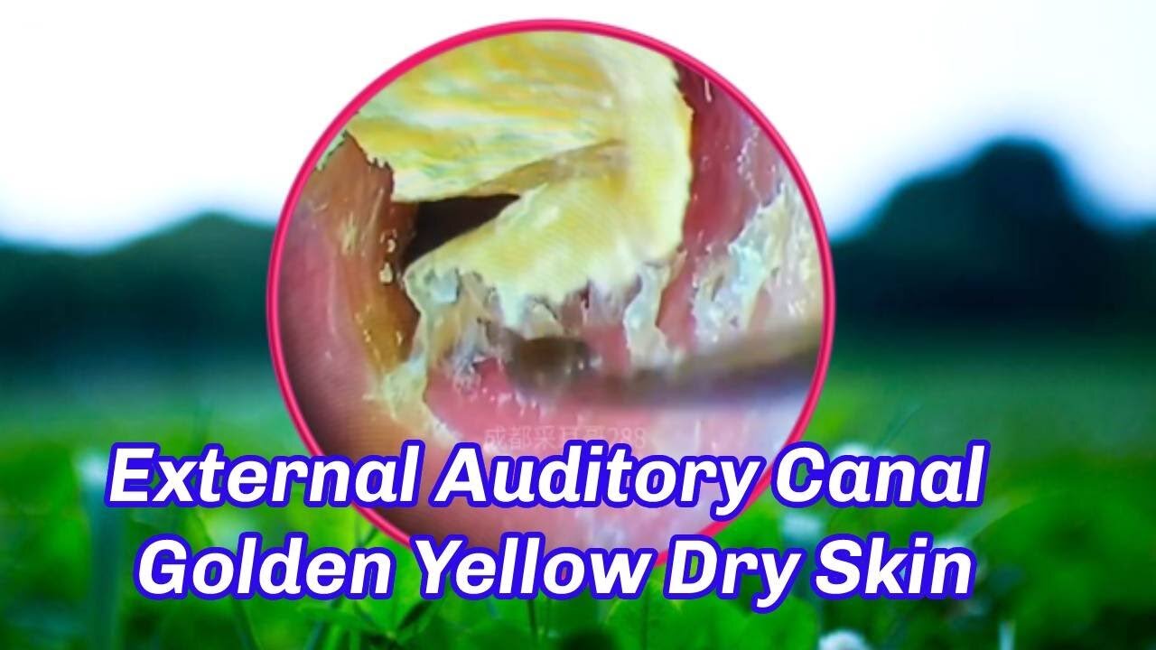 External Auditory Canal Golden Yellow Dry Skin