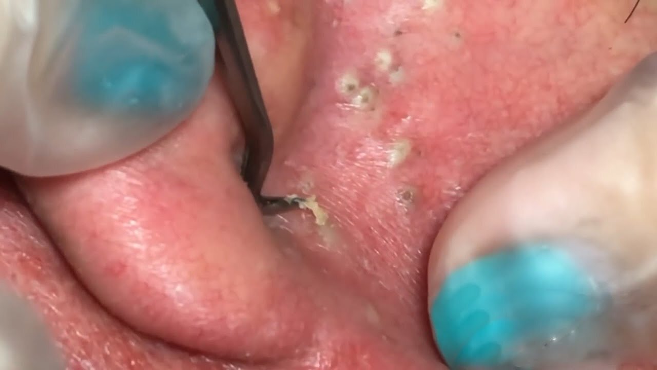 Extreme case of Ear Blackhead