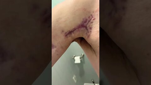 Finally Took Dressing off Surgery Scar!!! 🙂