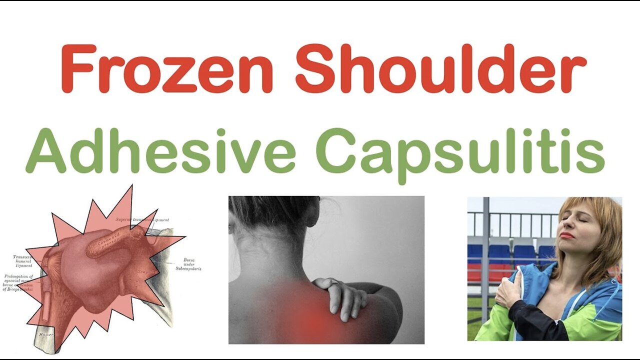 Frozen Shoulder (Adhesive Capsulitis): Causes, Symptoms, Stages, Diagnosis, Treatment