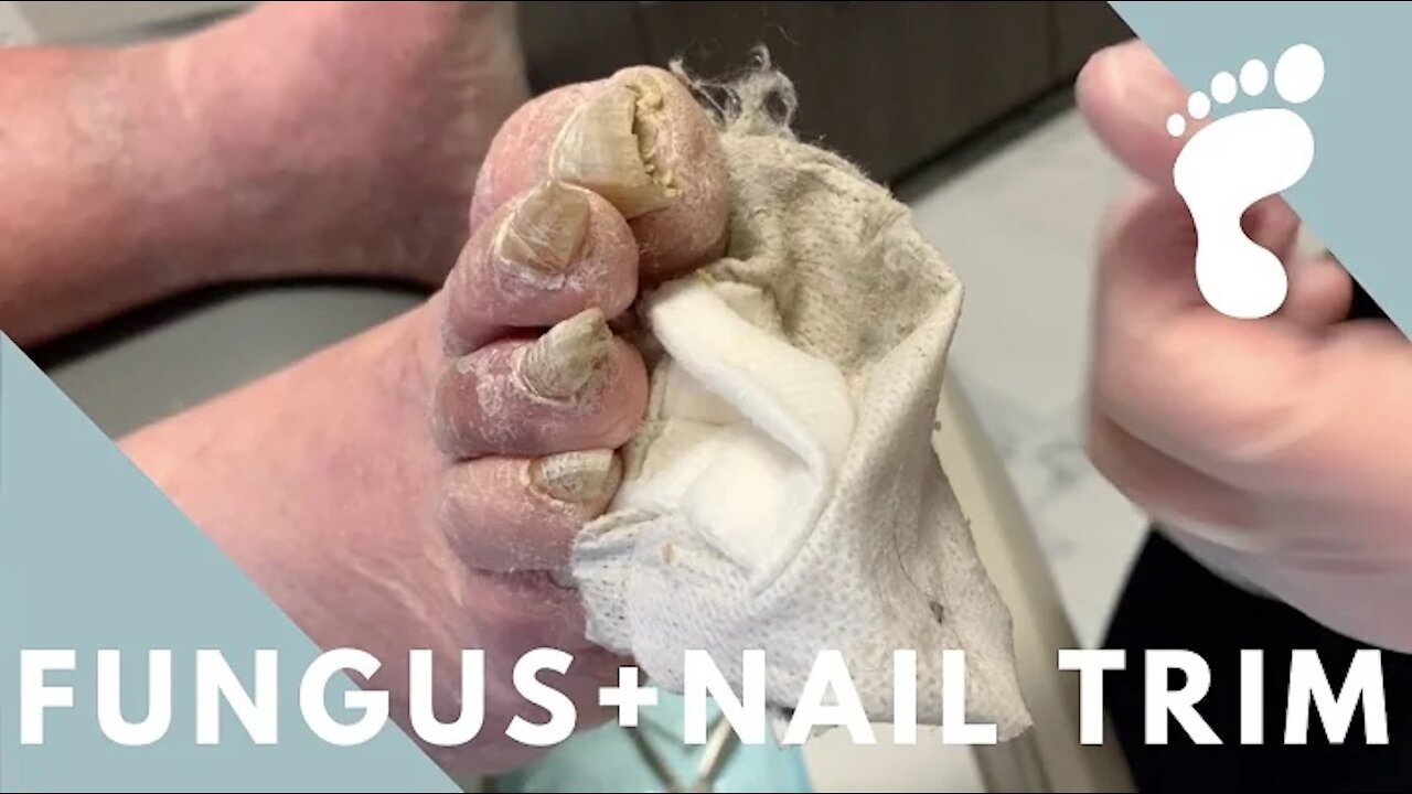 THICK NAIL Trick really works !